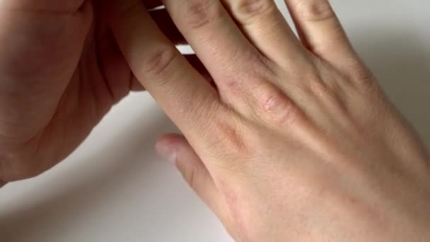 Handjes Controleren Droge Huid Sluiten Van Bewegende Handen Bekijken Hands — Stockvideo