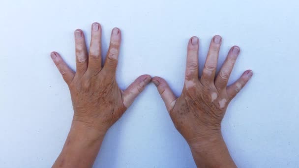 Una Mujer Mediana Edad Con Condición Piel Vitiligo Primer Plano — Vídeos de Stock