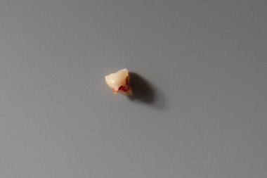 Gri arka planda bir bebeğin bebek dişi kayıp. Boşluğu kopyala.