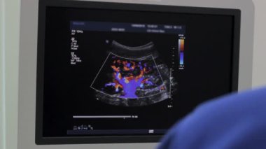 Yakın çekim, renkli Böbrek arteri bir ağaç gibi Ultrasonografi cihazları izlemek
