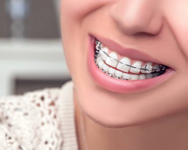 Braces. Orthodontic Treatment. Dental care Concept. Beautiful Woman healthy smile close up. Closeup Ceramic Braces on Teeth. Beautiful Female Smile with Braces. 