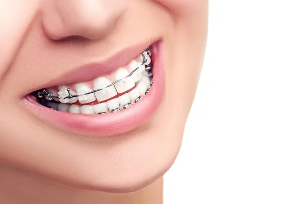 Een Beugel Orthodontische Behandeling Tandheelkundige Zorg Concept Mooie Vrouw Gezonde — Stockfoto