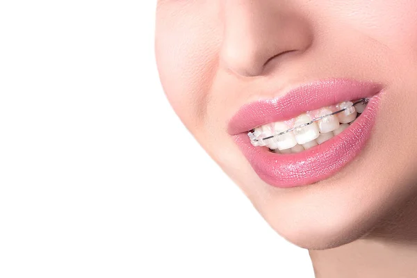 Fechar Aparelhos Cerâmicos Nos Dentes Linda Sorriso Feminino Com Braces — Fotografia de Stock