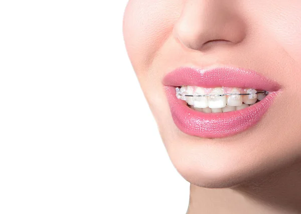 Closeup Keramische Beugels Tanden Mooie Vrouwelijke Glimlach Met Beugels Orthodontische — Stockfoto