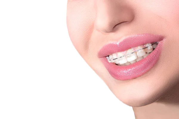 Nahaufnahme Keramische Zahnspangen Schönes Weibliches Lächeln Mit Zahnspange Kieferorthopädische Behandlung Stockbild