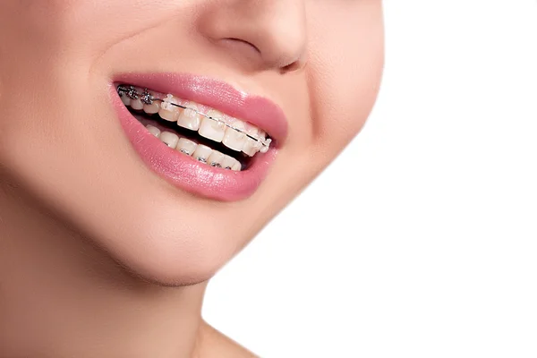 Braces Teeth Female Smile — Stock Photo, Image