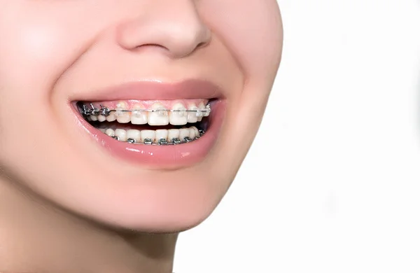 Cerámica dental ortodoncia dientes. Primer plano Sonrisa femenina. — Foto de Stock