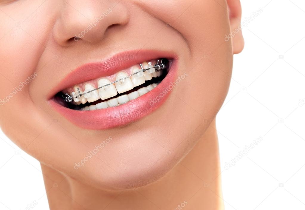 Orthodontic Treatment. Dental Brackets.