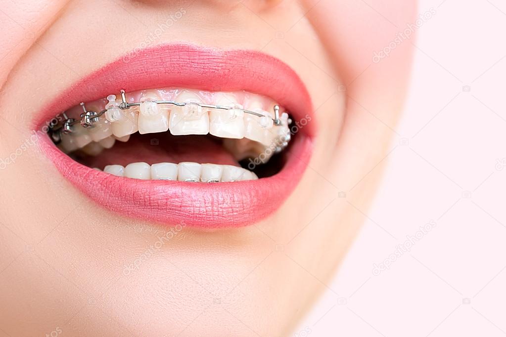 60+ Clip On Braces For Teeth Stock Photos, Pictures & Royalty-Free
