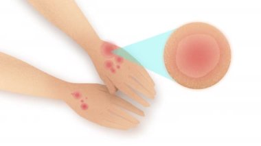 Sağlıklı deriden kızarıklıklara, her iki elde de kırmızı ve hassas cilde dönüşür.. 