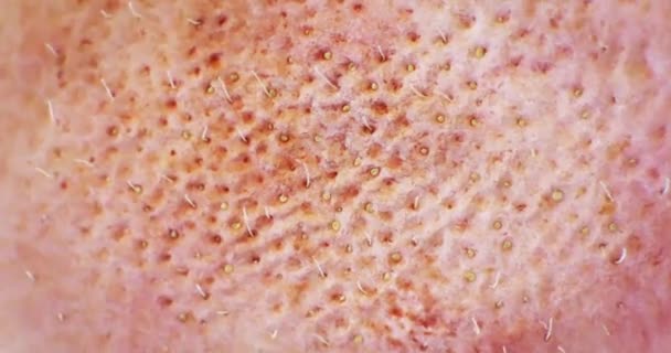 漂白剂 毛孔和污垢的细节 清洁过程 在清洁后又恢复清洁肌肤 — 图库视频影像