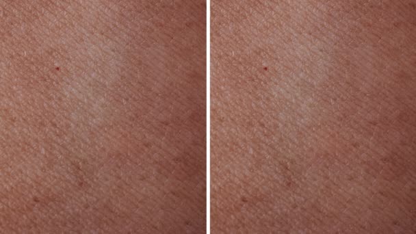 肩并肩的干色素皮肤和光泽的皮肤过程 — 图库视频影像