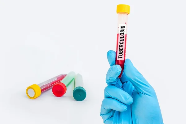 Zkumavky se vzorkem krve pro tuberkulózu test — Stock fotografie
