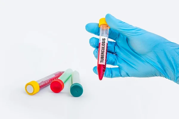 Tubo de ensaio com amostra de sangue para o teste de TUBERCULOSE — Fotografia de Stock