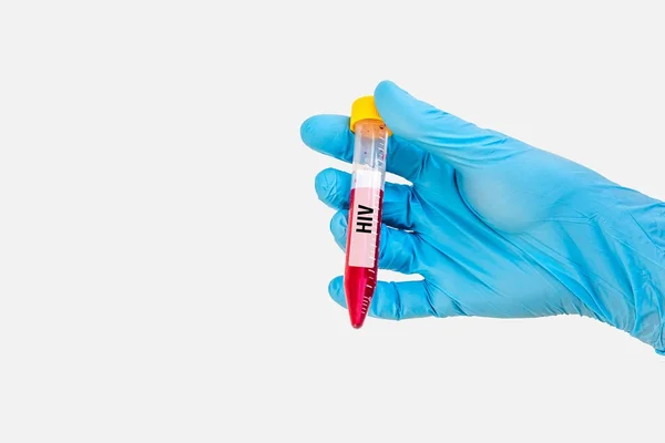 Hiv 또는 에이즈 테스트를 위한 혈액 샘플 시험 관 — 스톡 사진