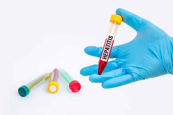 Zkumavky se vzorkem krve test hepatitida — Stock fotografie