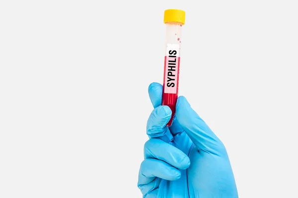 Zkumavky se vzorkem krve na syfilis test — Stock fotografie
