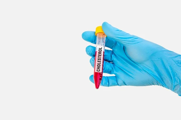 Tubo de ensaio com amostra de sangue para o teste CHOLESTEROL — Fotografia de Stock