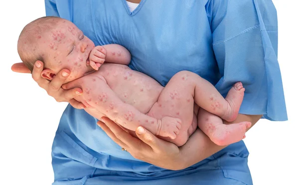 Doktor hasta kızamıkçık olan yeni doğmuş bir bebek tutan — Stok fotoğraf