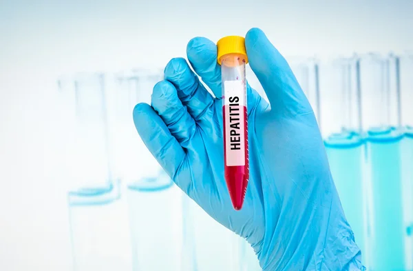 Тестовая трубка с образцом крови для анализа HEPATITIS — стоковое фото