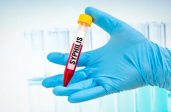 Δοκιμαστικό σωλήνα με δείγμα αίματος για τη σύφιλη δοκιμής — Φωτογραφία Αρχείου