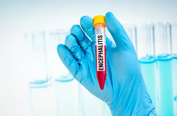 Тестовая пробирка с образцом крови для теста ENCEPHALITIS — стоковое фото