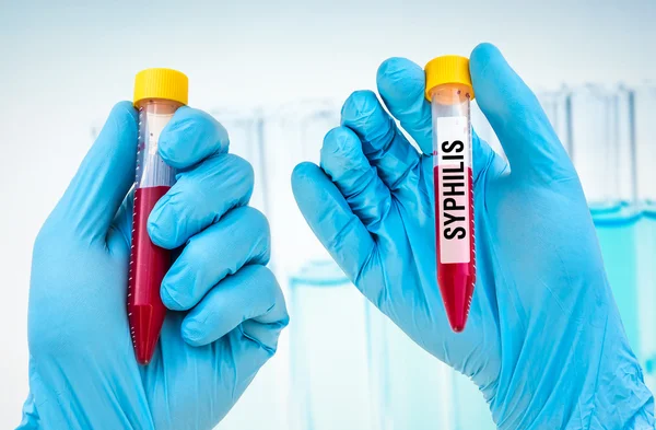 Пробирка с образцом крови для теста SYPHILIS — стоковое фото