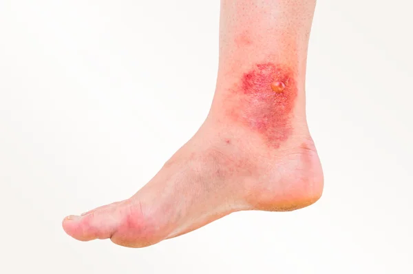 Червона висипка на нозі пацієнта, якого вкусила комаха — стокове фото