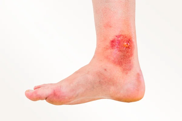Bir böcek tarafından ısırıldı hasta bacak üzerinde kırmızı döküntü