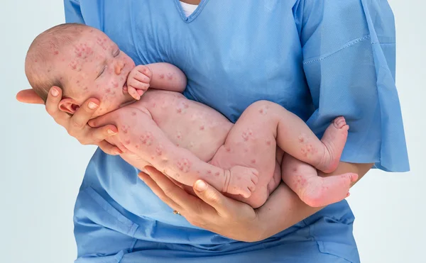 Läkaren håller ett nyfött barn som är sjuka röda hund eller mässling — Stockfoto