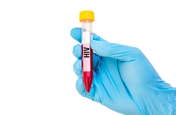 Test-tube with blood sample for HIV — Stock Photo, Image