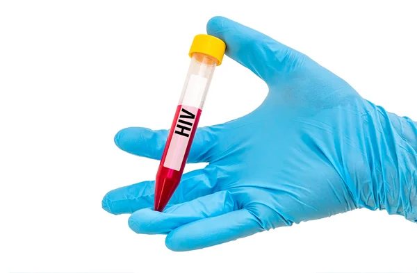 에이즈에 대 한 혈액 샘플 시험 관 — 스톡 사진