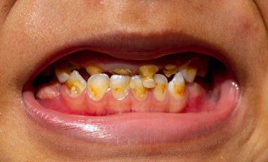 Ön dişlerinde diş bakımı olan bir çocuk. Diş sağlığı konsepti