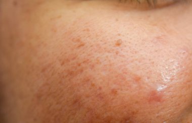 İnsan derisinin makro dokusu: Görünür gözenekleri, çilleri ve küçük bir köstebeği olan yanak ve buruna yakın çekim