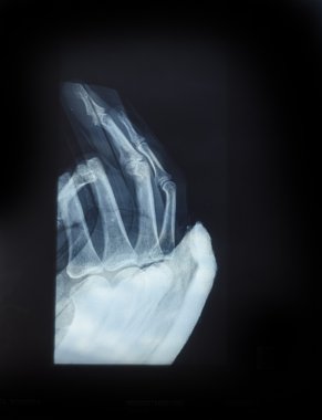 İnsan eli X-Ray görüntüsü