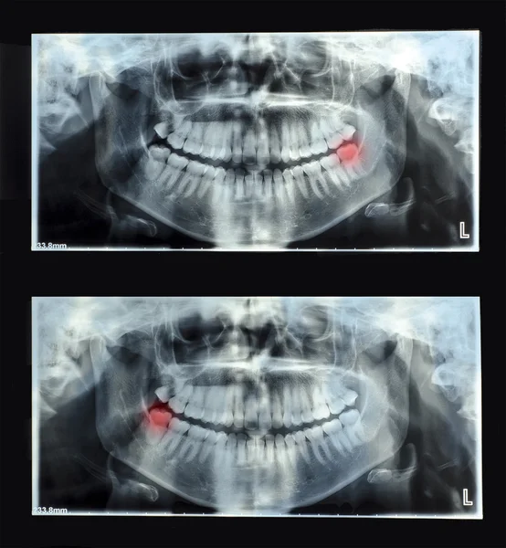 Panoramic dental x-ray  with superior upper wisdom tooth — Stock Photo, Image