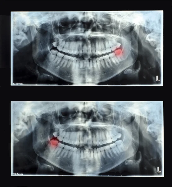 A jobb felső bölcsességfog panorámás fogröntgen — Stock Fotó