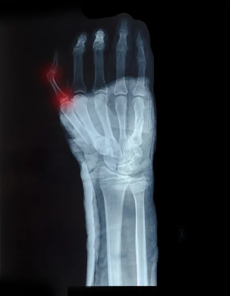 Küçük kırmızı gösterilen parmaklar insan eliyle X-Ray görüntüsü