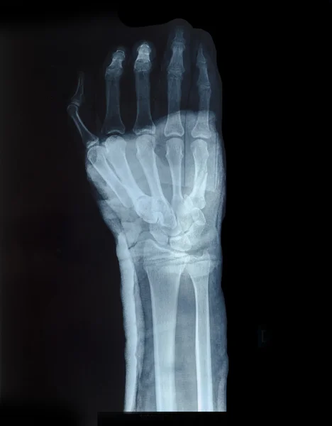 İnsan eli X-Ray görüntüsü