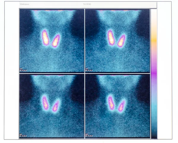 Сцинтиграфия щитовидной железы с двумя узлами — стоковое фото