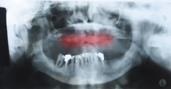 Панорамный рентген зубов пожилого человека с некоторыми нижними зубами — стоковое фото