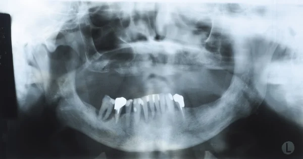 Panoramic dental x-ray of an old person with some lower teeth an — Stock Photo, Image