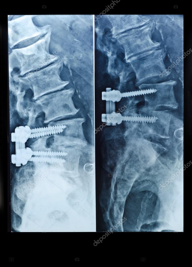 XRay image of spinal column with screws after surgery — Stock Photo