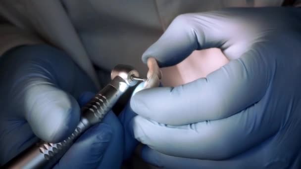 Dentista em luvas ajustar a macro prótese dentária — Vídeo de Stock