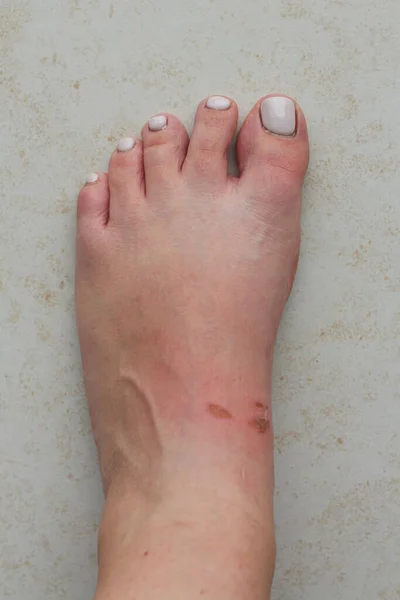 Womans voet met Bloody Wounds veroorzaakt door likdoorns. Probleem na het dragen van een nieuwe sandalen in de zomer — Stockfoto
