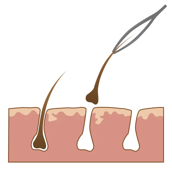 Exempel på hårborttagning från huden med pincett — Stock vektor