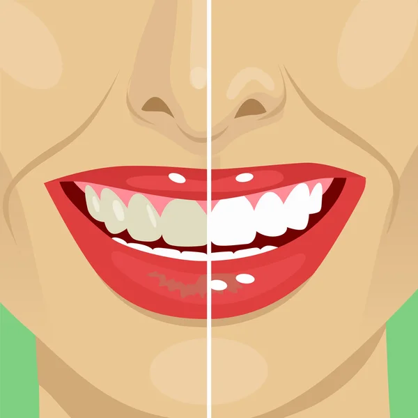 Sorriso perfeito antes e depois do branqueamento. Cuidados dentários e clareamento dos dentes — Vetor de Stock