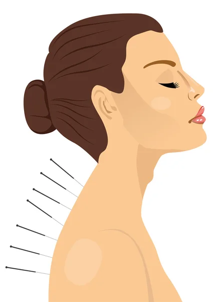 Mujer recibiendo un tratamiento de acupuntura — Vector de stock