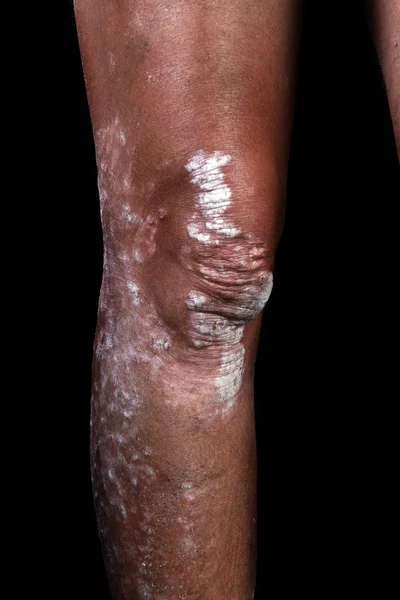 Een knie met psoriasis op een zwarte achtergrond — Stockfoto