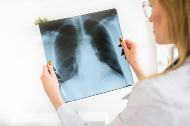 Genç bir doktor akciğerlerin fotoğrafını silecek. Zatürree veya tüberküloz teşhisi. Hastanın röntgen incelemesi..